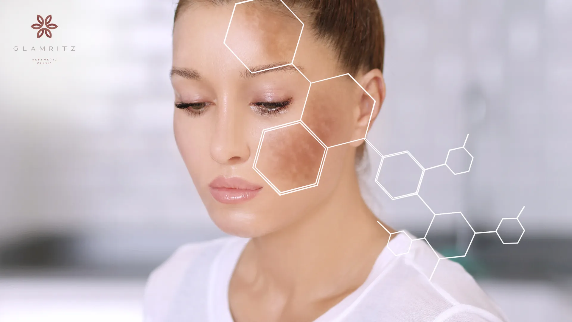 apa itu melasma pada wajah